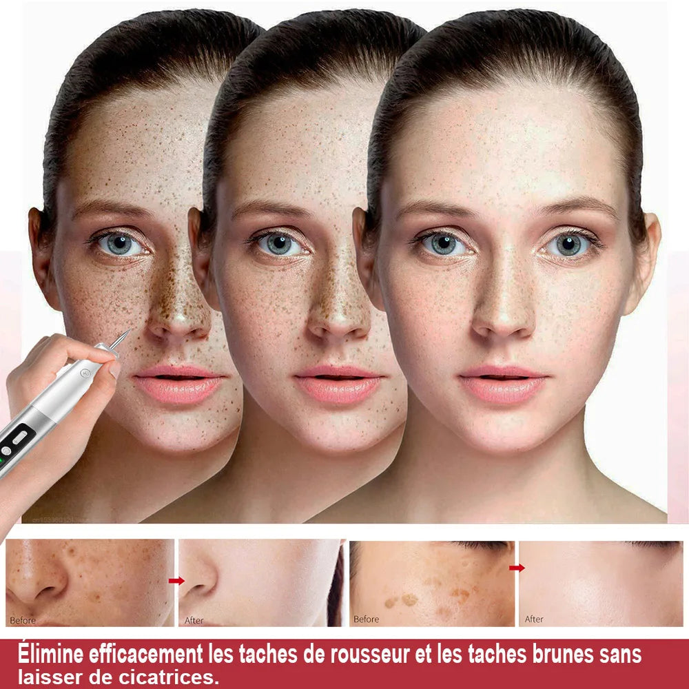 Skin Tag & Mole Remover Pen — Gentle Spot Correction, premium quality view
