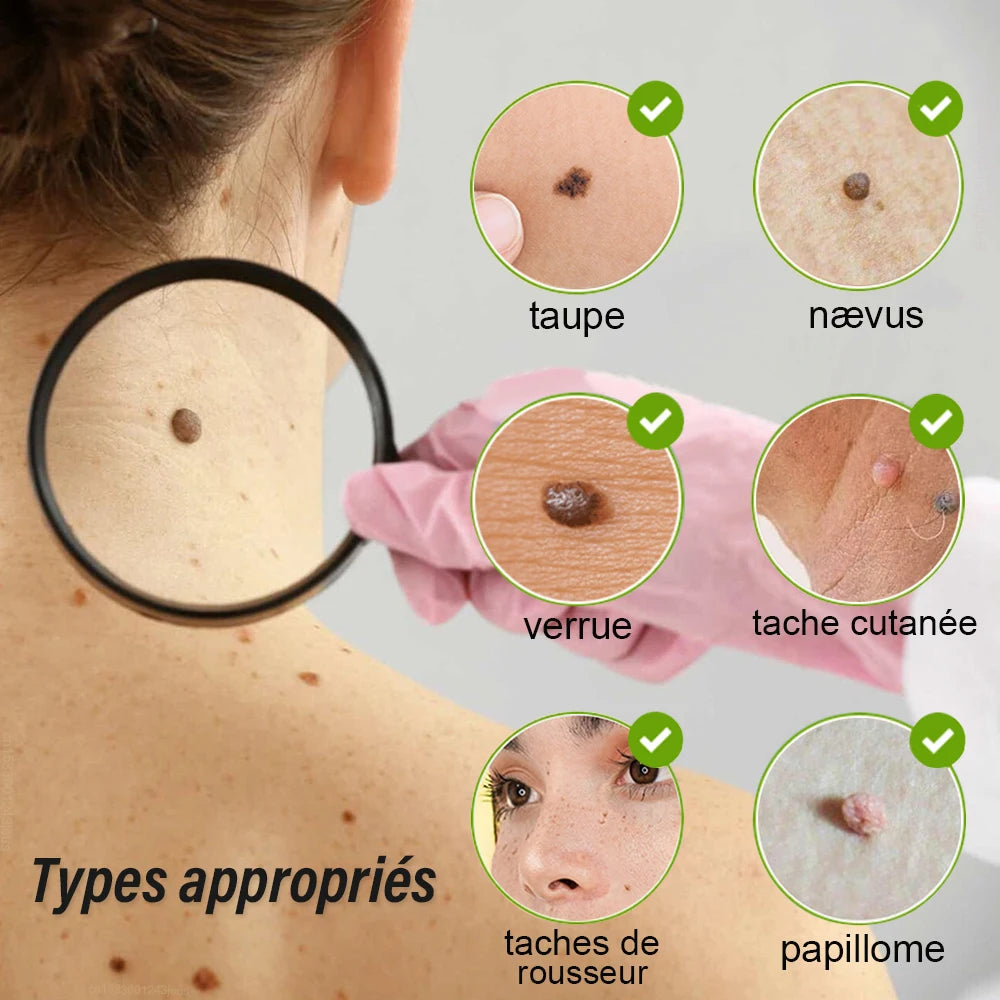 Skin Tag & Mole Remover Pen — Gentle Spot Correction, close-up detail